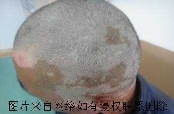 完全型白癜风有何症状?怎么去治疗